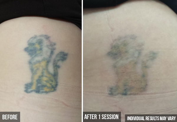 Two Tattoo Removal Sessions - Options for Different Size Tattoos