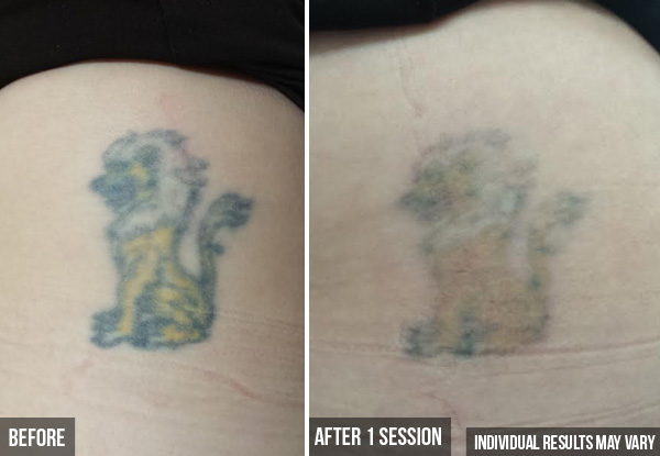 Tattoo Removal Session - Options for Different Size Tattoos