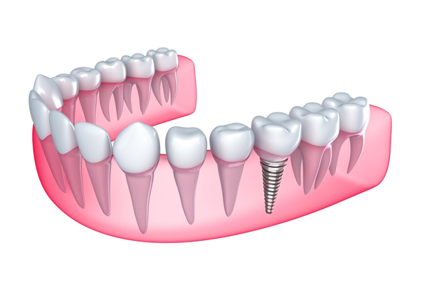 $3,499 for One Premium Titanium Dental Implant incl. Abutment, Implant Crown, All Appointments & Free Laser Teeth Whitening - $750 Deposit & Finance Option Available (value up to $8,600)