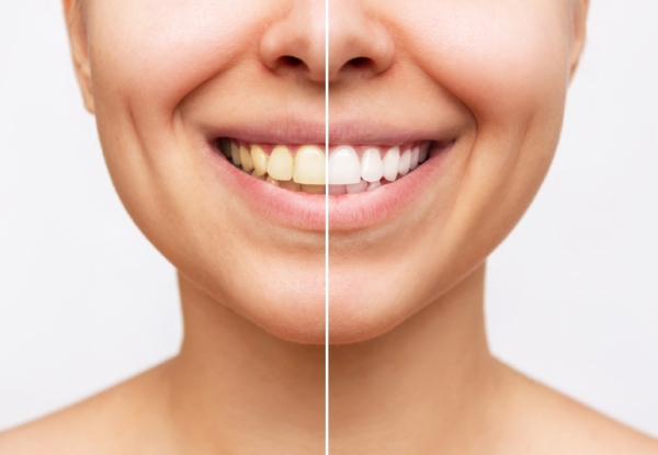 45-Minute Teeth Whitening Session