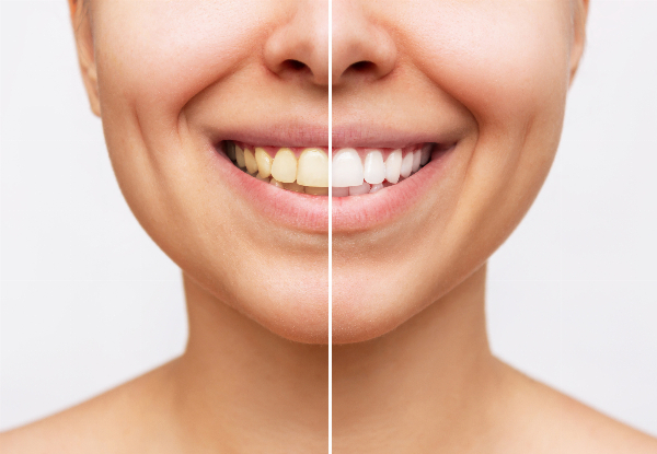 90-Minute Teeth Whitening Treatment at Maitreyah's Healing Studio
