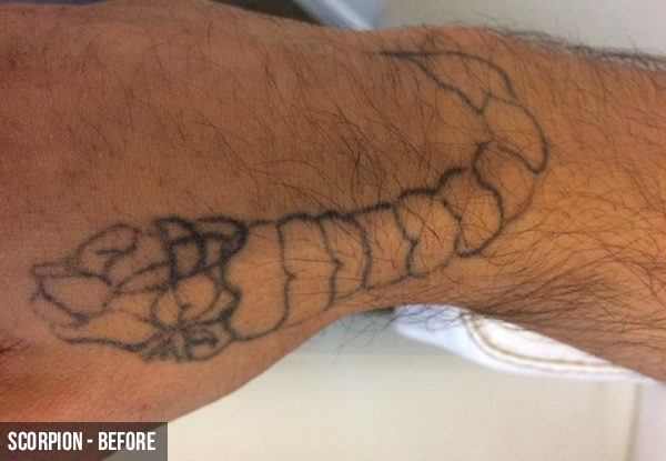 Three Laser Tattoo Removal Sessions