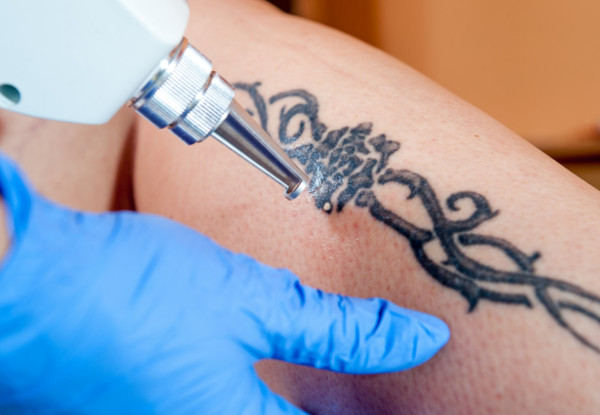 Three Laser Tattoo Removal Sessions for an Area up to 30cm2 - Options for One or Five Sessions