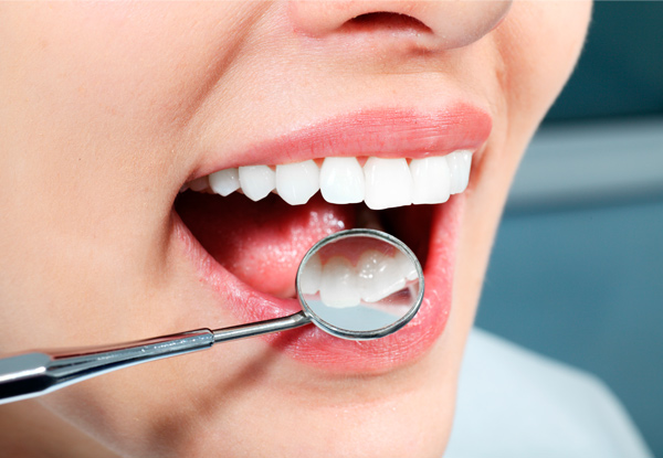 $79 for a 60-Minute Dental Package incl. Exam, Scale, Polish & X-Rays (value up to $300)
