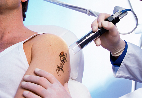 Tattoo Removal Archives - Sacred Laser