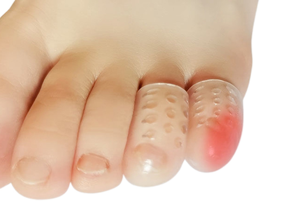 20-Piece Silicone Toe Protectors