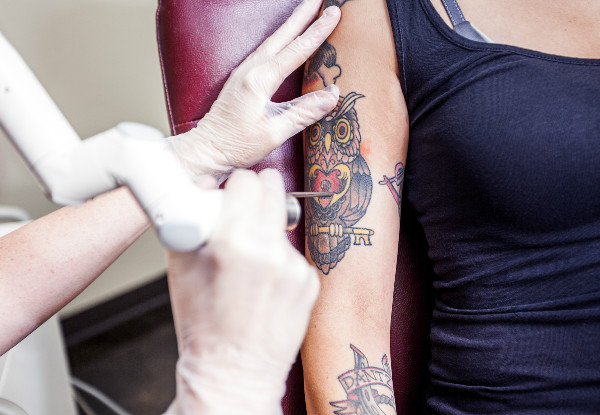 $100 Credit Towards Laser Tattoo Removal Services - Options for up to $400 Credit