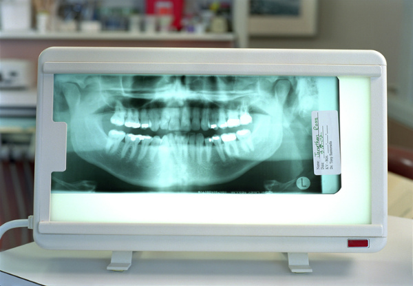 Professional Clean incl. Dental Exam, Any Necessary X-Rays, Scale & Polish