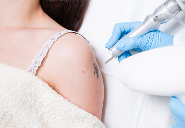 $139 for Three Laser Tattoo Removal Sessions for Areas up to 300cm² (value up to $1,050)
