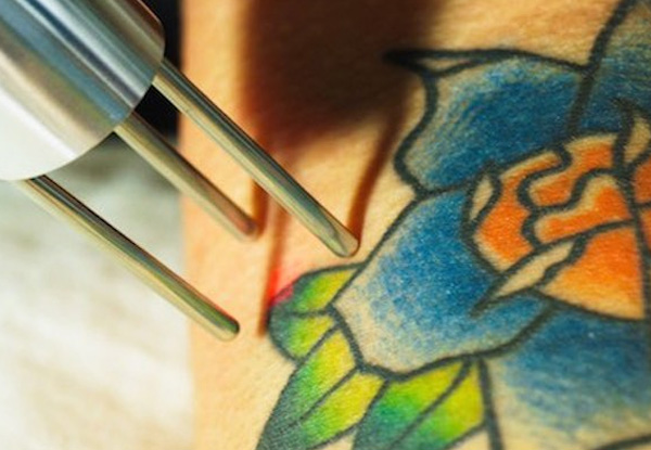 New charitable initiative launched to remove racist and extremist tattoos  for free - no regrets - NZ Herald