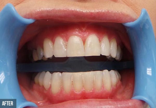 75-Minute Beyond Laser Teeth Whitening -
 Options for 90-Minute Beyond Laser Teeth Whitening or for 75-Minute for Two People