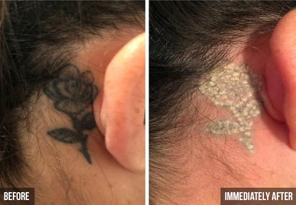 Laser Tattoo Removal Session - Option for Three Sessions