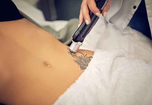 One Tattoo Removal Session - Options for Different Size Tattoos