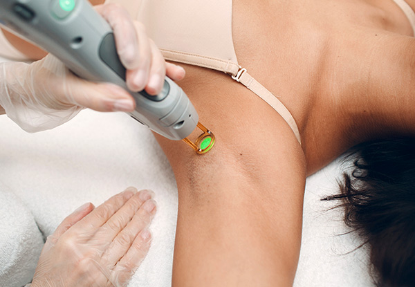 Brazilian & Under Arm EPI Laser Hair Removal Session - Options for Leg & Three Sessions Available
