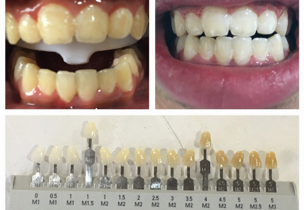 90-Minute Ultimate Teeth Whitening Session at Lovelysmiles Auckland