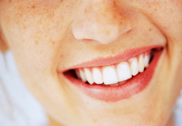 Teeth Whitening Package incl. Customised Whitening Trays, Whitening Gel & Kit, Scale & Polish