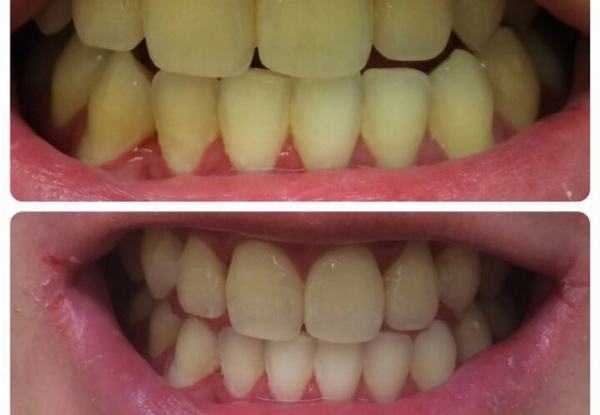 90-Minute Ultimate Teeth Whitening Session at Lovelysmiles Auckland