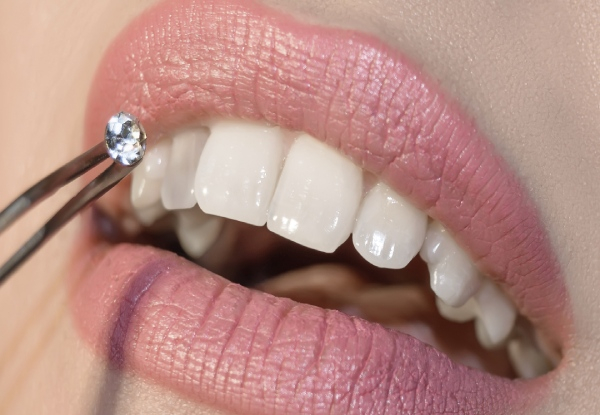 Teeth Whitening Treatment - Four Packages Available