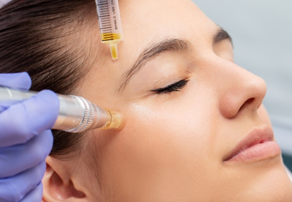 One Session of Collagen Induction Skin Needling