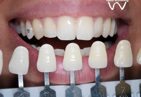 75-Minute Certified Teeth Whitening incl. Consult & Aftercare - Option for 90-Minute - Christchurch Location