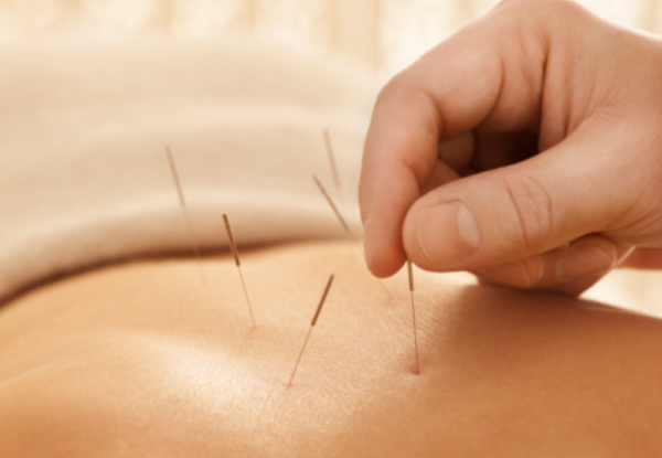 60-Minute Acupuncture Package incl. 15-Minute Deep Tissue Oil Massage - Option to incl. Cupping - Three Auckland Locations