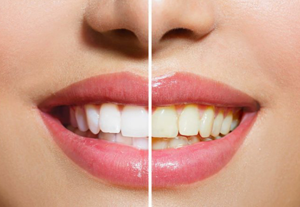 Teeth Whitening Package incl. Consultation, Lip Balm, Toothbrush & Whitening Pen or Whitening Gel for One Person - Option for Two People