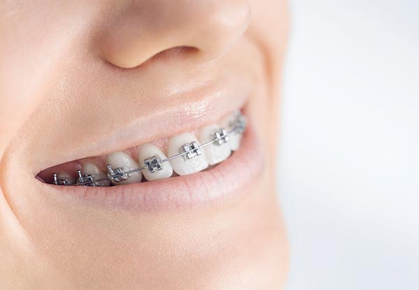 $2,000 Voucher Towards Fast Braces incl. Complimentary Orthodontic Assessment