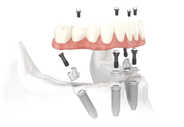 Premium Dental Implant - Options to incl. a Travel Voucher to Auckland