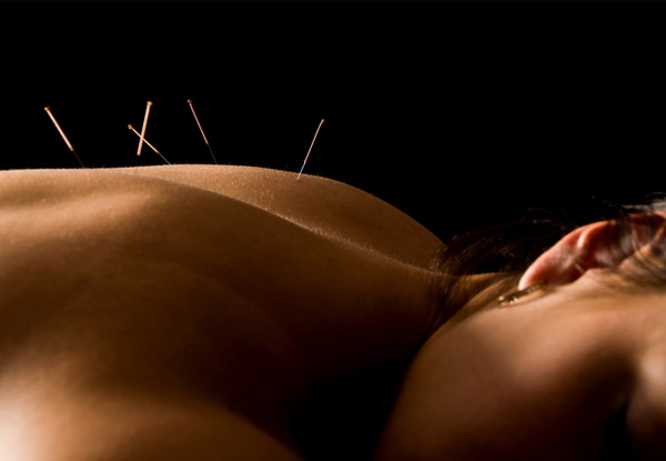One-Hour Consultation & Acupuncture Treatment - Options for ACC Accepted Injuries & Non-ACC Patients