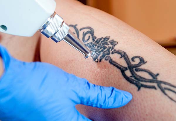 Three Tattoo Removal Sessions - Options for Different Sizes & Six Treatments