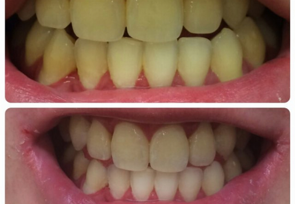 90-Minute Ultimate Teeth Whitening Session at Lovelysmiles Wellington CBD