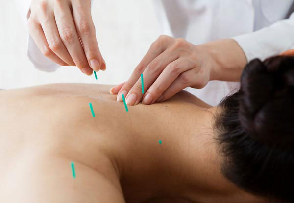 One-Hour Acupuncture or Sports Massage Session - Options for Two or Three Sessions Available