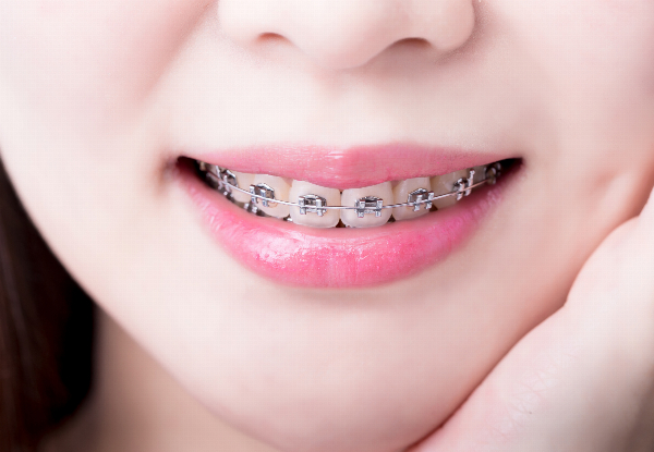All Inclusive Braces Teeth Straightening Package incl. Consultation, All Appointments, Braces Application, Removal & Post-Braces Teeth Whitening - Option for Invisalign Package
