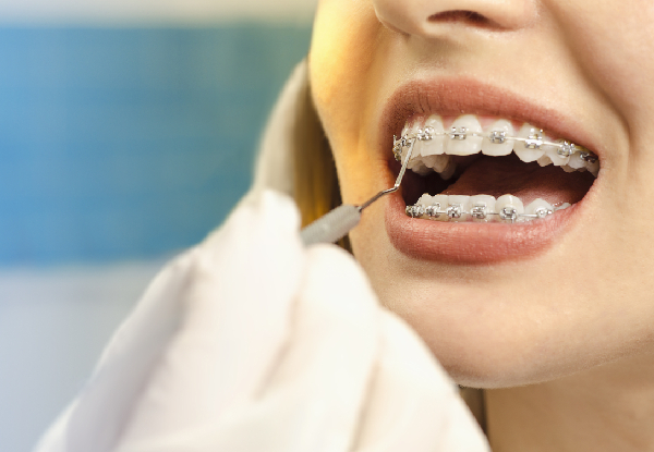 $500 Deposit Towards Braces or Clear Aligner for One Person
