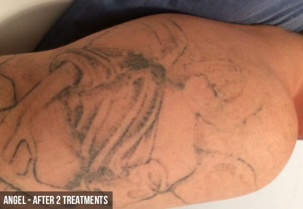 Three Laser Tattoo Removal Sessions