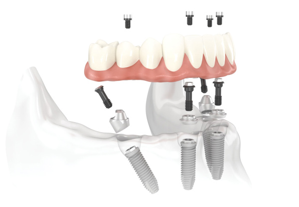 $1,599 for One Premium Titanium Dental Implant & 3D Scan or $3,999 to incl. an Ultra Premium Abutment & Crown – Options for up to Five Implants