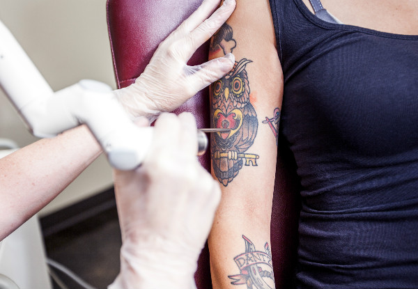 $100 Credit Towards Laser Tattoo Removal Services - Options for up to $400 Credit