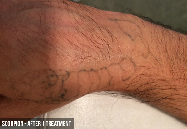 Three Laser Tattoo Removal Sessions