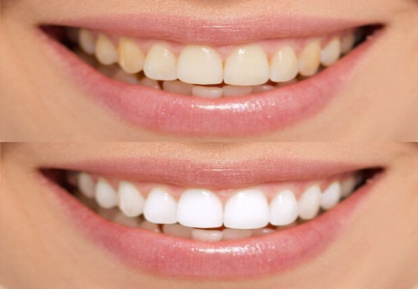 30-Minute Laser Teeth Whitening Treatment - Option for 60-Minute Treatment