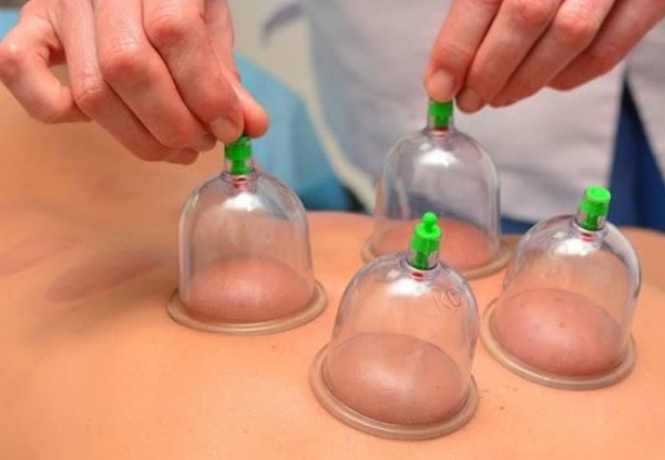 30-Minute Cupping Session for One Person - Options for Facial Scraping or Acupuncture