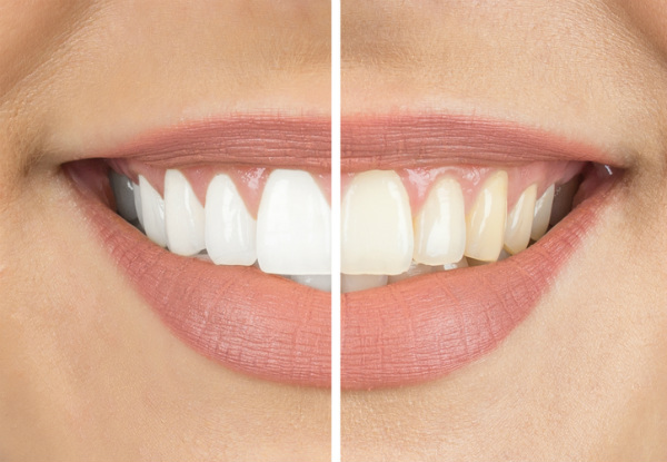 90-Minute Professional Teeth Whitening Treatment for One Person