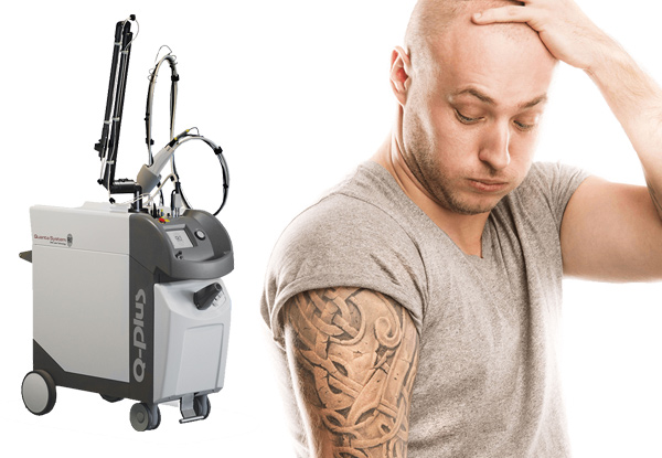 Tattoo Removal Session - Options for Different Size Tattoos