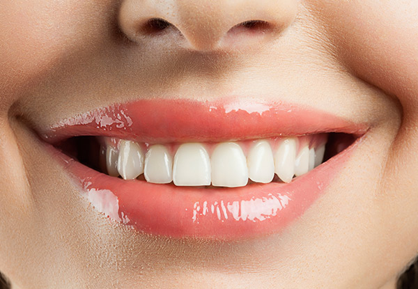 60-Minute Sensitivity & Pain-Free Whitening Package (NZ FernMark Accredited) - Options for 75-Minutes, or 90-Minutes or for Two People – Two Auckland Locations