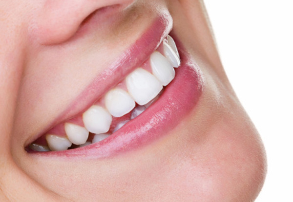 Teeth Whitening Package incl. Customised Whitening Trays, Whitening Gel & Kit, Scale & Polish