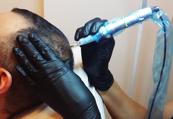 Scalp Micropigmentation Density Package - Options for Small, Medium, Large Patch or Full-Head