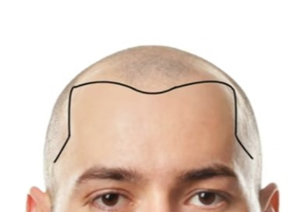 Scalp Micropigmentation for Men – Option for Half-Head & Full Head