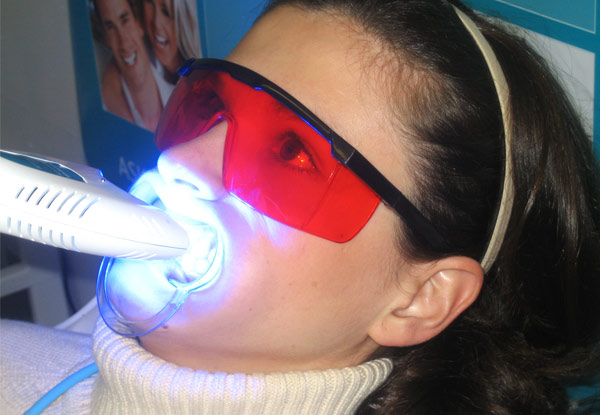 One Teeth Whitening Session