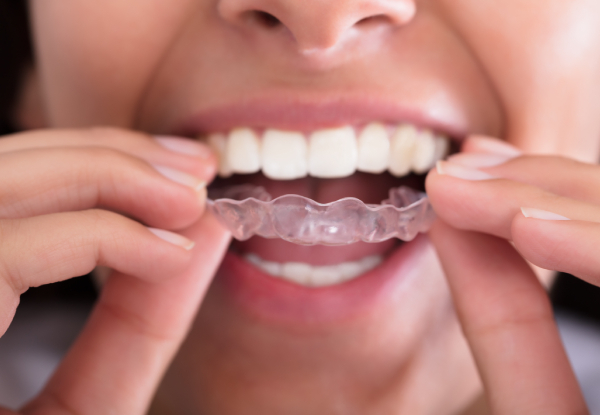Deposit Towards Invisalign incl. All X-Rays, Appointments, Laser Teeth Whitening with Clean, Scale & Polish for One Person