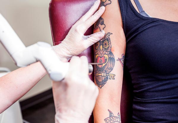 Laser Tattoo Removal incl. Initial Consultation & a 20-Minute Laser Treatment - Option for Two or Three 20-Minute Laser Tattoo Removal Treatments