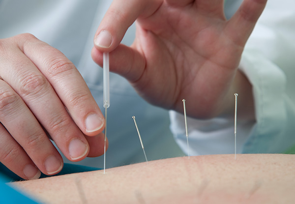 One 60-Minute Acupuncture Session incl. 15-Minute Initial Consultation - Option for Two or Three Sessions